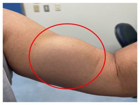 美魔女重訓拉斷二頭肌　術後3週重回健身房