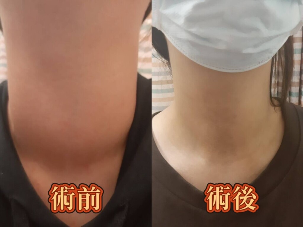 如釋重負　微創手術助兩女生甩掉「大脖子」