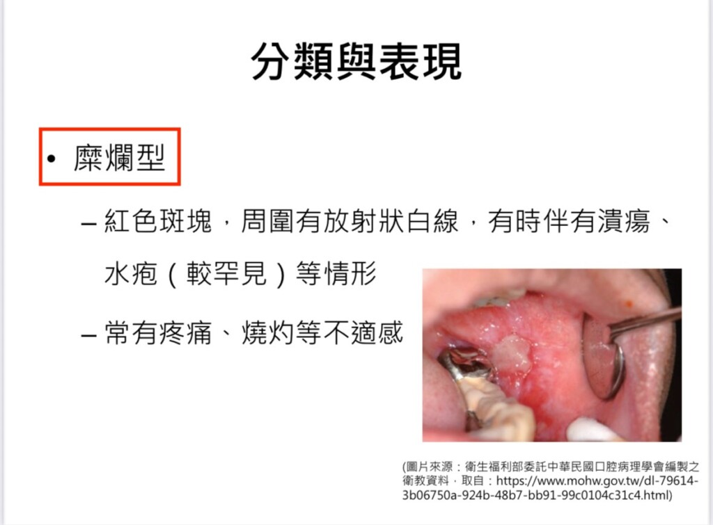 反覆嘴破、黏膜發白    醫示警：恐是扁平苔癬悄來襲