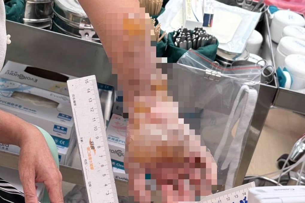 中秋烤肉玩「冷光仙女棒」出事！7支同時閃燃　台南婦手掌燒黑