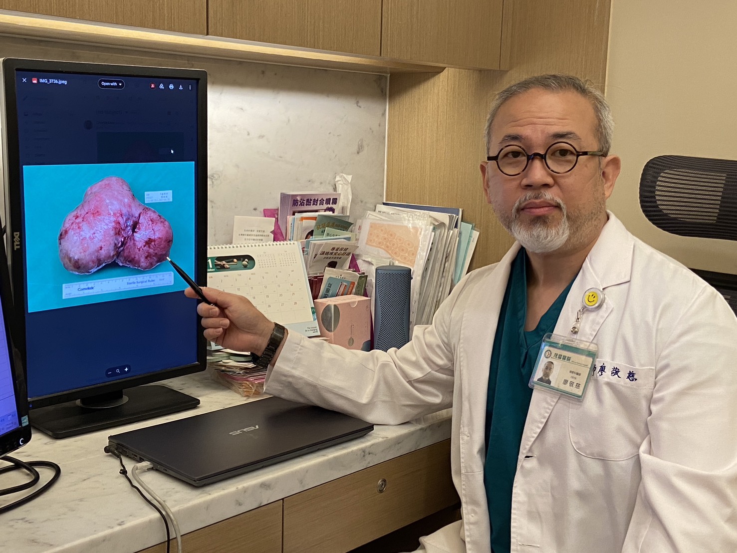 試管孕媽驚見肌瘤暴增15公分  剖腹產肌瘤一併切除