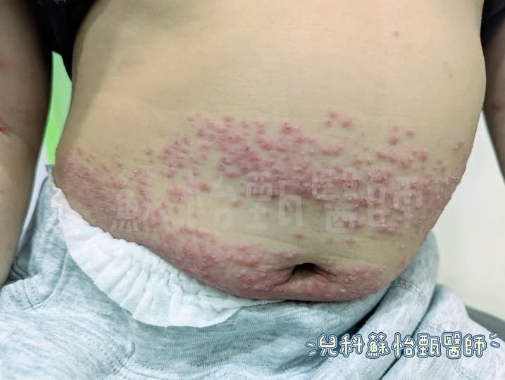 4歲童肚子長滿密密麻麻水泡！醫驚「沒遇過這麼多」竟完全沒發燒